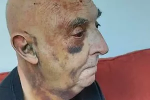 A person with a bald head and visible bruising on the side of their face sits on a red couch, gazing to the left. The background is plain.